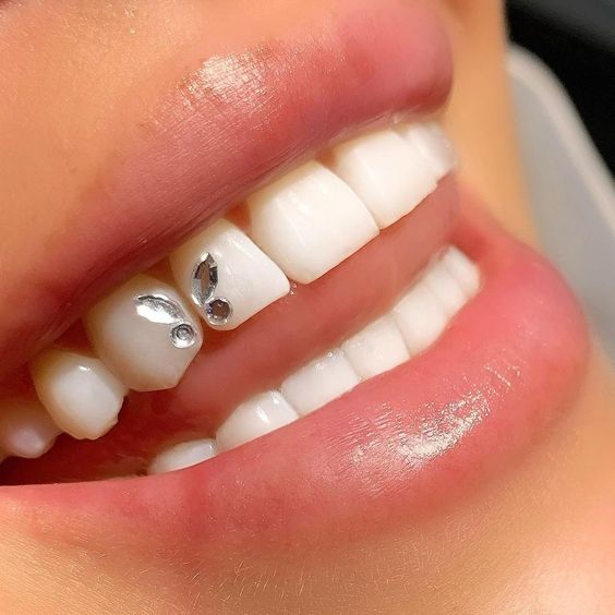 Tannsmykking i Larvik – tannkrystall settes skånsomt